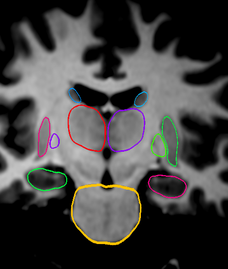 _images/overlays_vtkmodel2.png
